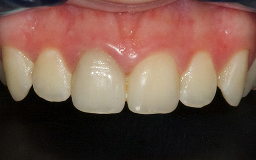 Tooth whitening and ceramic crowns after