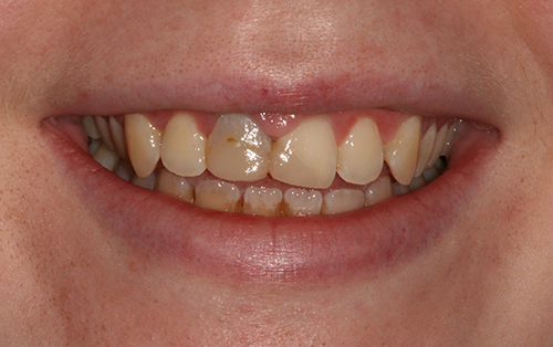 Tooth whitening and ceramic crowns before