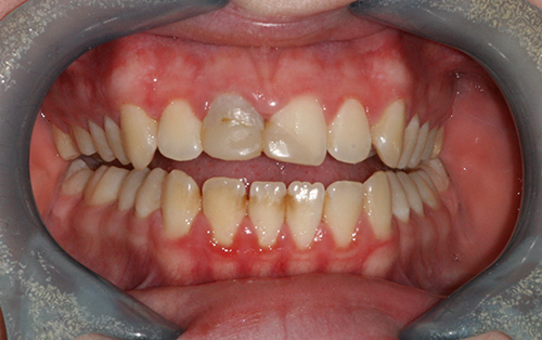 Tooth whitening and ceramic crowns before