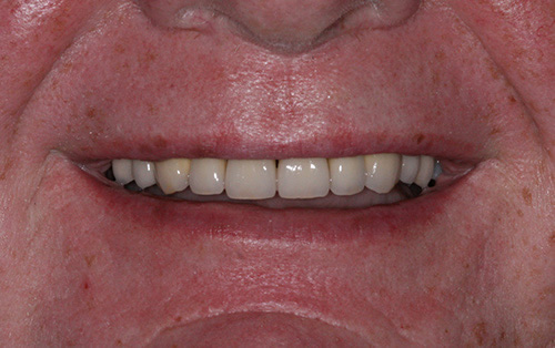 Full mouth reconstruction after