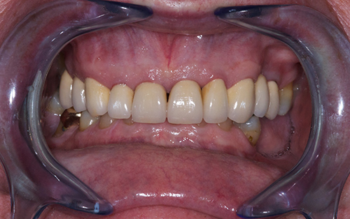 Full mouth reconstruction after