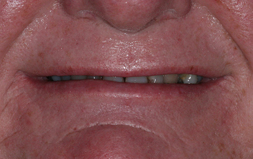 Full mouth reconstruction before