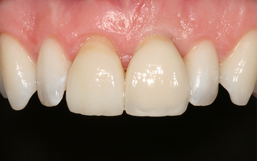 Single tooth implant after