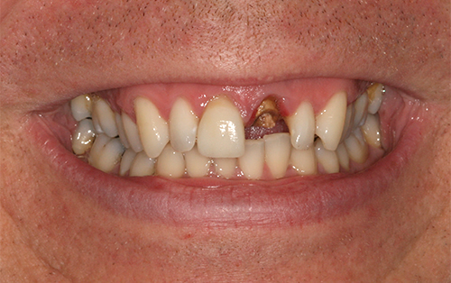 Single tooth implant before